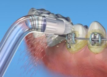 A szájzuhany alábecsült szerepe a fogápolásban